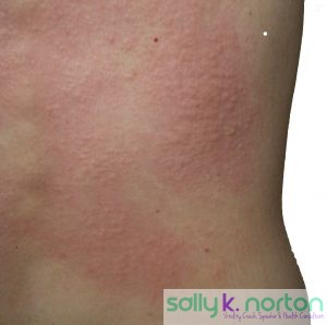 Rash on a person's back